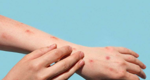 Armenia health ministry: Vaccination against smallpox is 85% effective for mpox as well