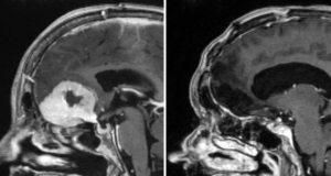Scotland neurosurgeon removes apple-sized brain tumors from patients' eyebrows