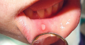 How not to “miss” the development of oral cancer