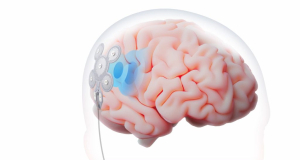 UK trials brain implant that could improve mood
