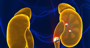 Nature: three types of fatty acids increase the risk of kidney stone formation