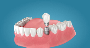Clinical Implant Dentistry and Related Research: Dental implants still functional after 40 years, study finds