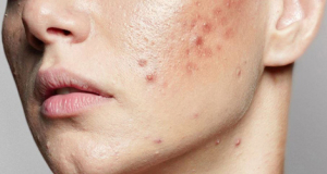 Dangers of popular acne creams named
