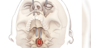 Teen girl’s large spinal tumor removed through her eye socket