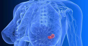 U.S. Approves First-of-Its-Kind AI-Based Platform to Predict Breast Cancer Risk in Women