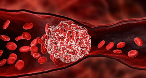 Nature: New Compression-Based Device Removes Blood Clots in 90% of Cases