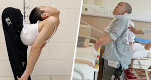 "Bent Boy" in China Stands Upright for the First Time After Complex Surgeries