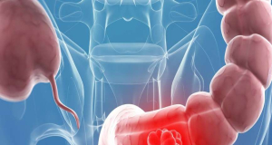 Four Subtle Symptoms of Bowel Cancer