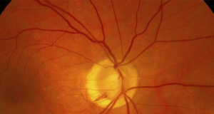 CD: Risk of heart attack and stroke can be assessed from photo of fundus