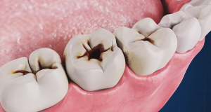 Cell Host & Microbe: AI can predict early childhood tooth caries risk with over 90% accuracy, study shows