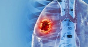 Scientists Learn to Detect Lung Cancer Mutations by Measuring Nanoparticle “Stiffness”