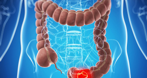JAMA Oncology: ультрапереработанные продукты повышают риск рака кишечника