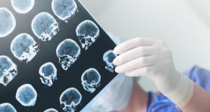 Why People Who Have Survived Cancer Are Less Likely to Develop Alzheimer&rsquo;s Disease