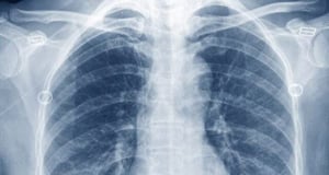 Patient survives 2 days without lungs for first time