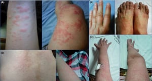 Nearly 30-Year Mystery Solved: Scientists Discover How Familial Mediterranean Fever Begins