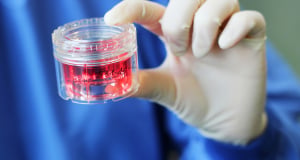 Donor Stem Cell Transplants Offer Hope of Long-Term Survival in Rare Aggressive Lymphoma