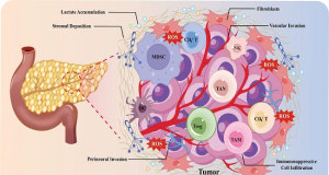 Patient with Metastatic Pancreatic Cancer Remains Disease-Free for More Than Three Years After Experimental Treatment