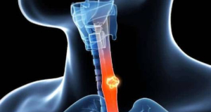Japan Becomes First Country in the World to Launch Viral Therapy for Esophageal Cancer