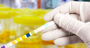 At-Home Urine Test Could Detect Most Bladder Cancer Cases, Study Finds