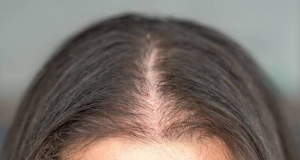 AMA Dermatology: у пациентов с облысением волосы отросли при помощи упадацитиниба