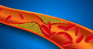 NEJM: Atherosclerotic Plaques May Appear in the Arteries as Early as Age 18
