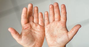 В США зарегистрировали первые смерти от кори за 35 лет