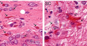 After 30 Years of Research, First Drug Developed for Rare Progressive Brain Disease