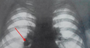 NEG: 71% of People with Pulmonary Nodules Are Non-Smokers