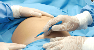 Chronic pain after cesarean delivery can affect women for years, study finds