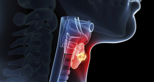 Neuron: Lymph Node Removal Associated With a 25% Rate of Cognitive Impairment