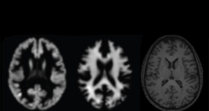 PLOS Medicine: сильнее всего &laquo;возраст мозга&raquo; опережал реальный при деменции