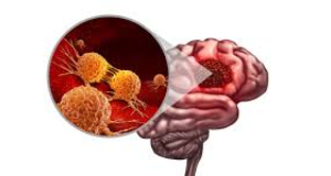 Glioblastoma Forces Brain Cells to Help It Grow: Study Reveals a New Mechanism