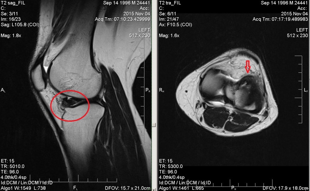 Разрыв мениска коленного сустава симптомы фото