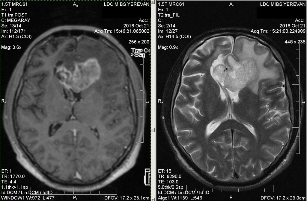 Как выглядит опухоль головного мозга на мрт фото